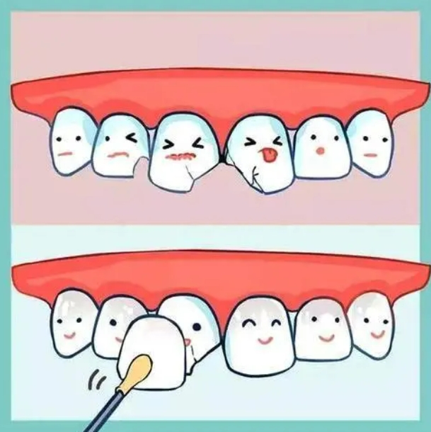 牙齿贴片有哪些缺点和潜在风险吗？