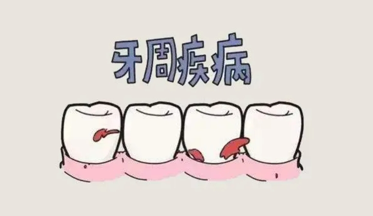 什么是牙周病？有哪些症状区分？