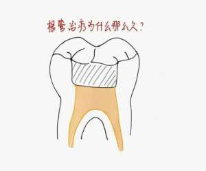 根管治疗的牙又疼了怎么办？