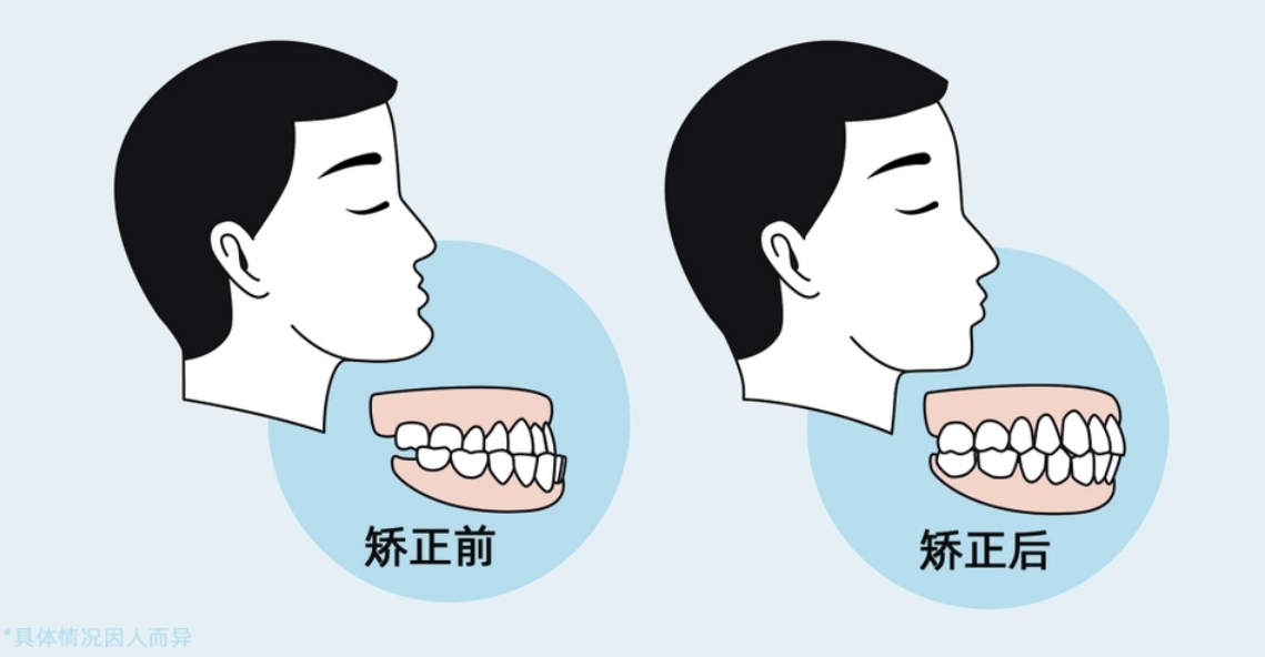 牙齿咬合不齐，矫正需要多长时间呢？
