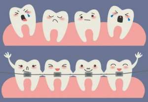 牙齿矫正，选隐形还是钢牙？