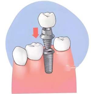 影响种植牙使用寿命的关键因素是什么？