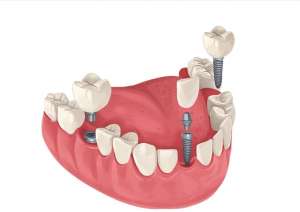 活动假牙和种植牙：如何根据自身条件做出明智选择？