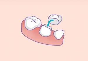 拔牙后为什么不能吃面条？背后原因有哪些？