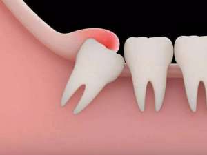 种植体周围发炎了，牙齿还能保住吗？