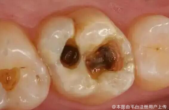 蛀牙不补的危害，如何预防和治疗蛀牙？