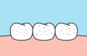 牙齿矫正选哪一种材质比较好？