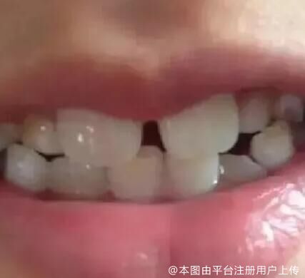 多生牙的危害有哪些呢？多生牙一定要拔么？