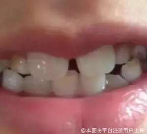 多生牙的危害有哪些呢？多生牙一定要拔么？