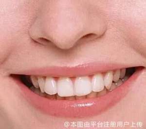 牙齿矫正是否会导致牙齿移动？