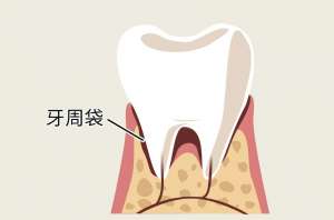 做烤瓷牙后还能洗牙吗？