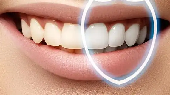 烤瓷牙多少钱一颗？门牙烤瓷牙能使用多久？